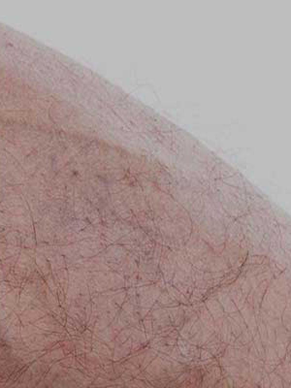 Aesthetic-implications-of-varicose-veins